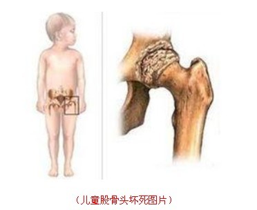 儿童股骨头坏死预防