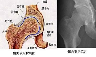 沈阳专业治疗股骨头坏死的医院